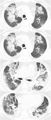 Six-Month Outcomes of Post-ARDS Pulmonary Fibrosis in Patients With H1N1 Pneumonia